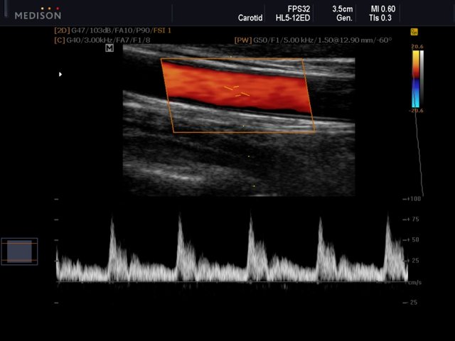 Общая сонная артерия, CFM и PW (эхограмма №556)