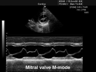 Митральный клапан, М-режим