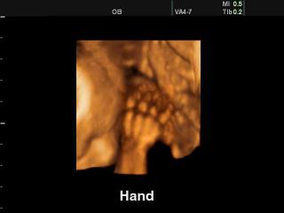 SonoAce 8000 Live: Рука плода, 3D