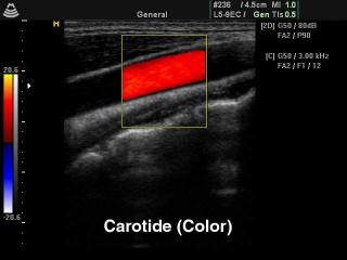 Общая сонная артерия, цветное картирование