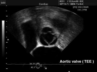 Аортальный клапан (черезпищеводный доступ), B-режим