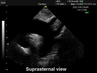 Сердце (субкостальный доступ), B-режим