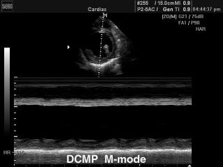 Кардиомиопатия, М-режим