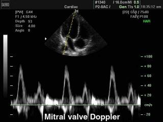 SonoAce 9900: Митральный клапан, импульсный допплер
