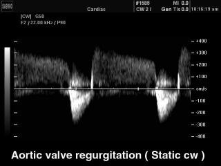 Регургитация аортального клапана, CW