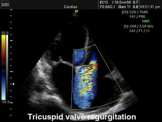 Регургитация трикуспидального клапана, цветной допплер