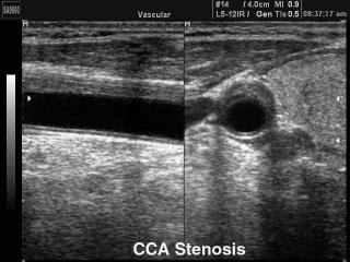 Стеноз общей сонной артерии, B-режим