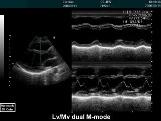 SonoAce 6000 CMT: Левый желудочек и митральный клапан, М-режим