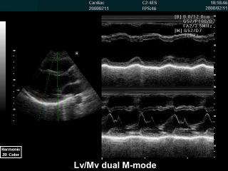 Левый желудочек и митральный клапан, М-режим