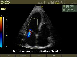 Регургитация митрального клапана, цветной допплер