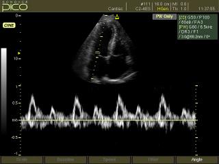 SonoAce Pico: Митральный клапан, импульсный допплер