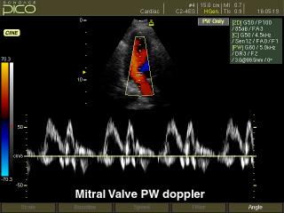 SonoAce Pico: Митральный клапан, CFM и PW