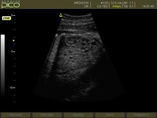 SonoAce Pico: Почка плода, B-режим