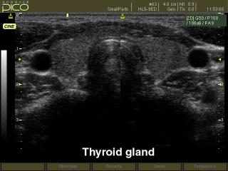 Щитовидная железа, B-режим
