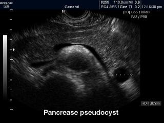 Псевдокиста поджелудочной железы, B-режим