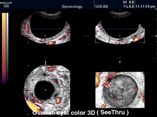 Ксиста яичника, энергетический допплер и 3D