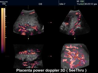Плацента, энергетический допплер, 3D