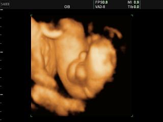 SonoAce 8000 Live: Мужские половые органы у плода, 3D