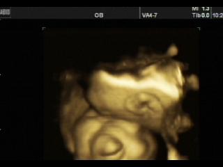 SonoAce 8000 Live: Анэнцефалия - порок развития плода, 3D