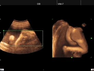 SonoAce 8000 Live: Ягодицы плода, 3D