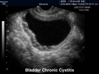 Мочевой пузырь - хронический цистит, B-режим