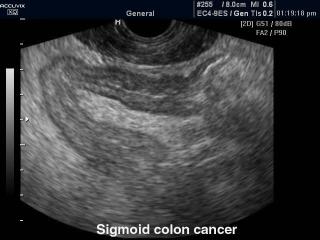 Рак сигмовидного отдела толстой кишки, B-режим