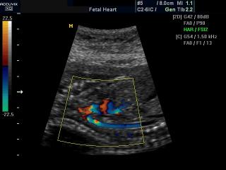 Сердце плода - дуга аорты, цветное картирование