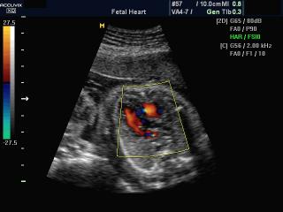Сердце плода - ВТЛЖ, цветное картирование