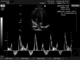 Сердце - кровоток через трансмитральный клапан, импульсный допплер