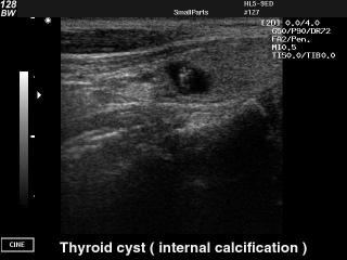 Щитовидная железа - киста с кальцификатом, B-режим