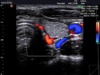 Щитовидная железа и ОСА, цветное картирование
