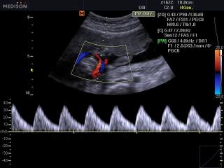 Плод - артерия пуповины, CFM и PW