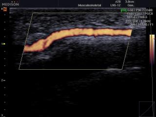 Кровоток в мягких тканях кисти, энергетический допплер