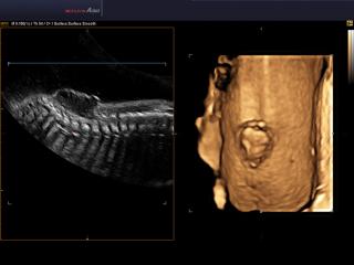Accuvix A30: Spina bifida - порок развития плода, 3D
