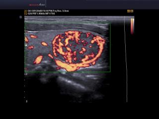 Щитовидная железа - аденома, энергетический допплер