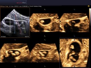 Accuvix A30: Камни желчного пузыря, Multi OVIX, 3D
