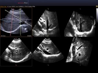 Accuvix A30: Печень, Multi OVIX, 3D
