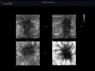 Рак грудной железы, B-режим