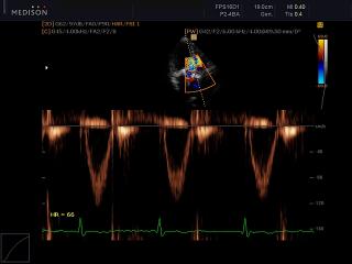Аортальный клапан, CFM и PW
