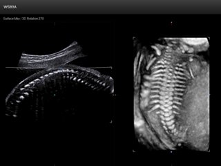 Позвоночник плода, ClearVision