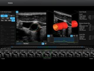 RS80A-RUS: Общая сонная артерия, S-3D Arterial Analysis