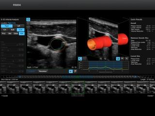 Общая сонная артерия, S-3D Arterial Analysis