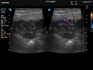 Почка - нефробластоматоз, В-режим и ЦДК