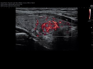 Щитовидная железа, узел, MV-Flow