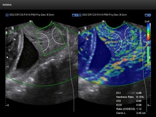 Шейка матки, эластография