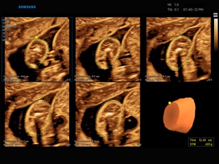 W9-RUS: Плод, 5D Limb Vol