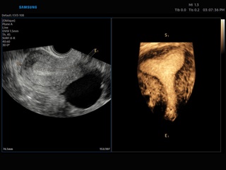 Матка, Uterine Contour