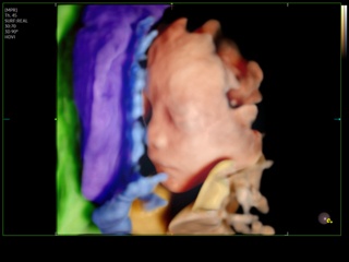 Z20-RUS: Плод, EzVolume™