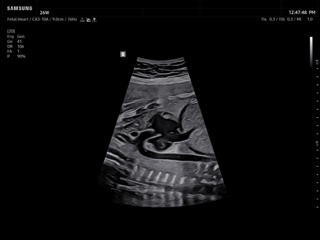 Z20-RUS: Сердце плода, Luminant™