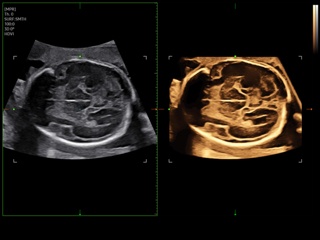 Z20-RUS: Головной мозг плода, Slice A